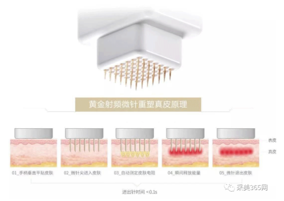 韩国jeisys intracel 5d黄金微针-专业做黄金射频微针项目的仪器_采