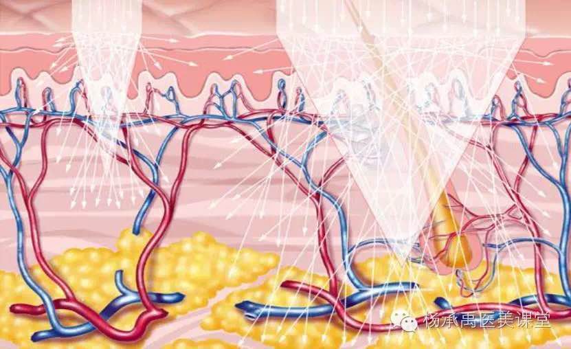 激光与皮肤组织的作用