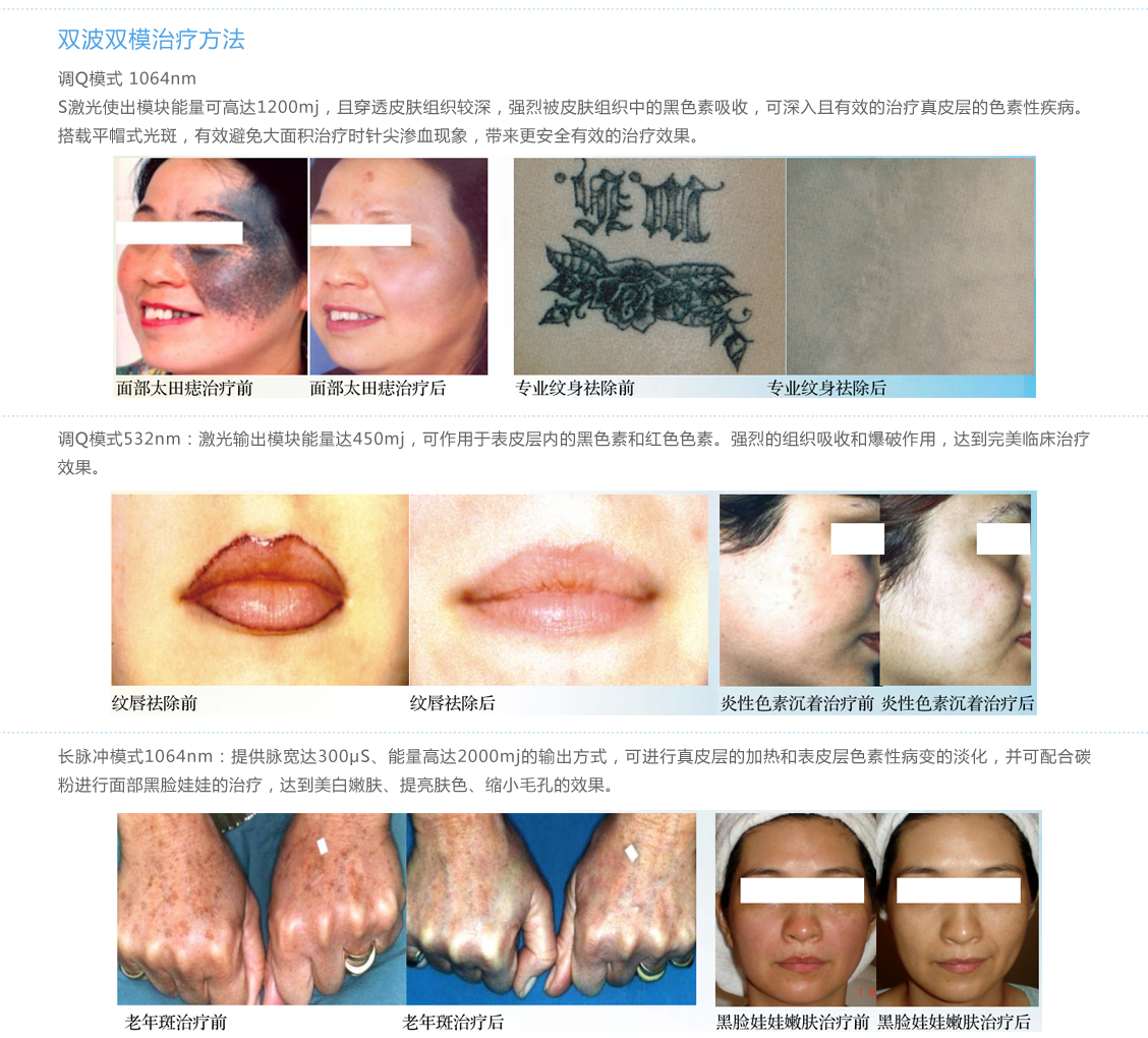 调Q、美白、嫩肤、缩小毛孔、双波双模