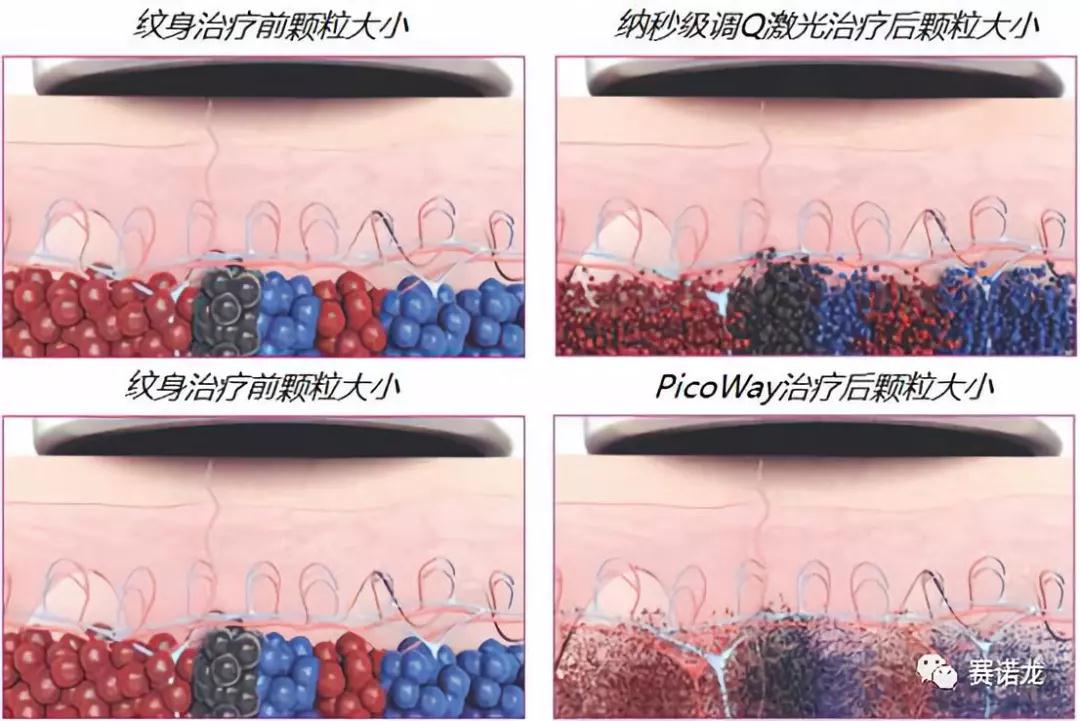 直播中,kethy已经介绍过了,比起纳秒级别的传统激光,皮秒激光在治疗