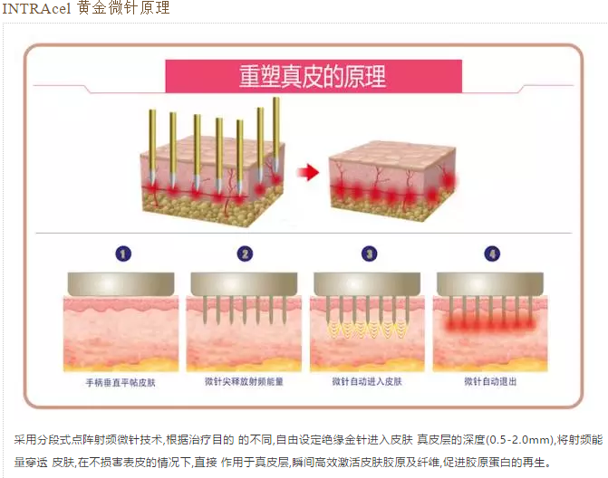 intracel黄金微针射频治疗仪黄金微针射频射频治疗仪