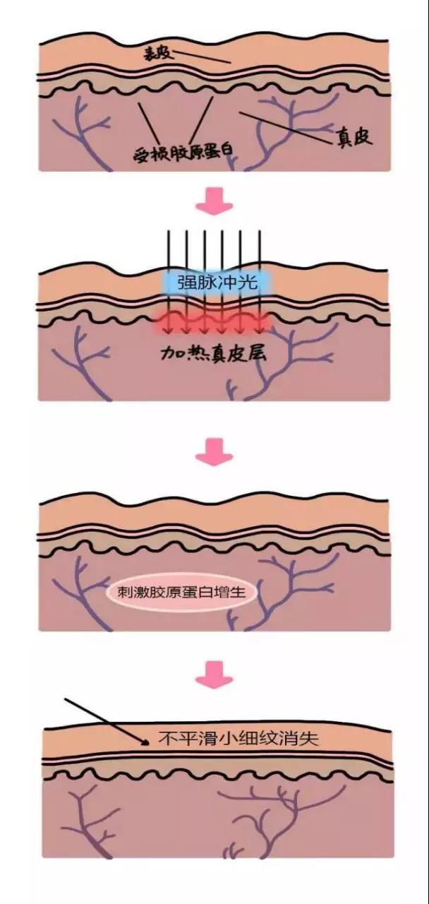 皇后光子嫩肤仪能解决哪些问题