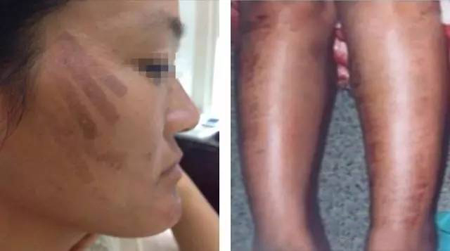 19种色素性病变详细讲解 有图有真相 采美365网