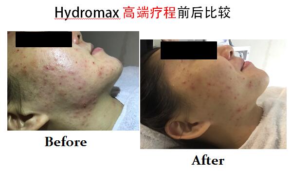 Hydromax 水钻石临床效果3