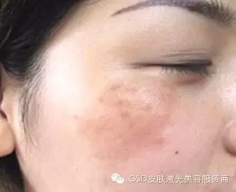 如何正确分辨色斑种类 采美365网