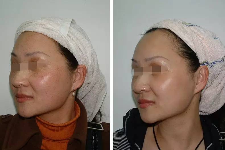 德国大Q色素激光临床效果对比