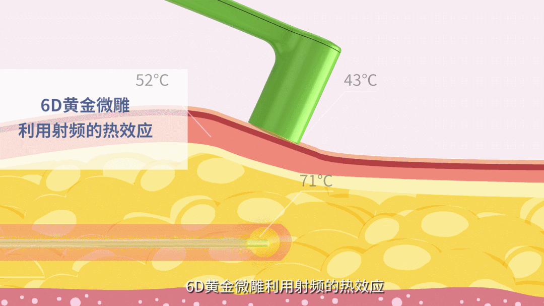 采美科普如何轻松瘦身6d黄金微雕让瘦身更简单