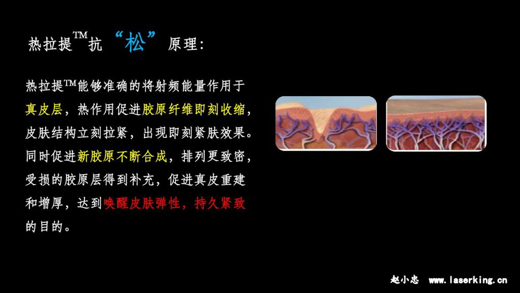 热拉提抗“松”原理