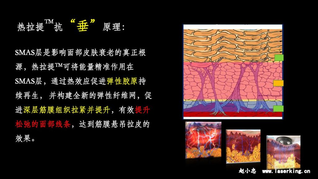 热拉提抗“垂”原理