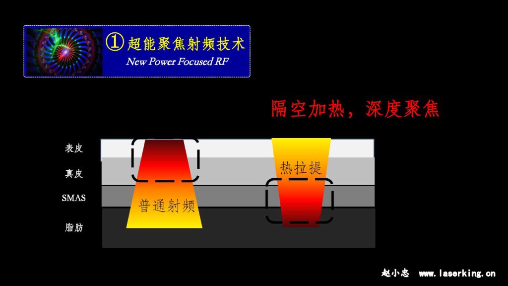 热拉提超能聚焦射频技术:隔空加热,浓度聚焦