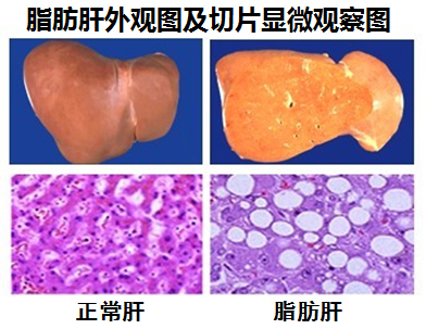 Lipo-EX深热塑：脂肪肝外观图及切片显微镜观察图