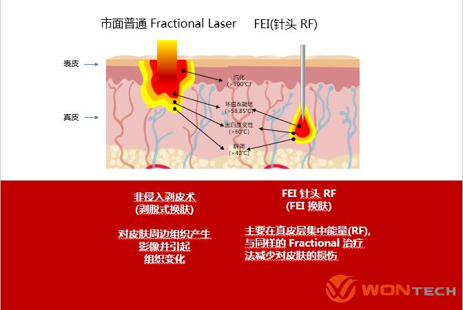 FEI(妃)黄金射频微针的不同,FEI(妃)黄金射频微针作用原理,盘点热门黄金微针