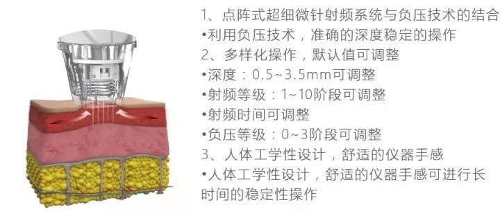 Focus S ,黄金射频微针2代工作原理,黄金微针盘点