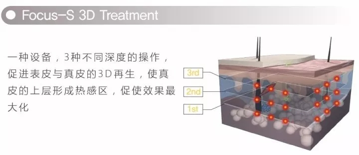 Focus S 黄金射频微针2代工作原理,黄金微针盘点