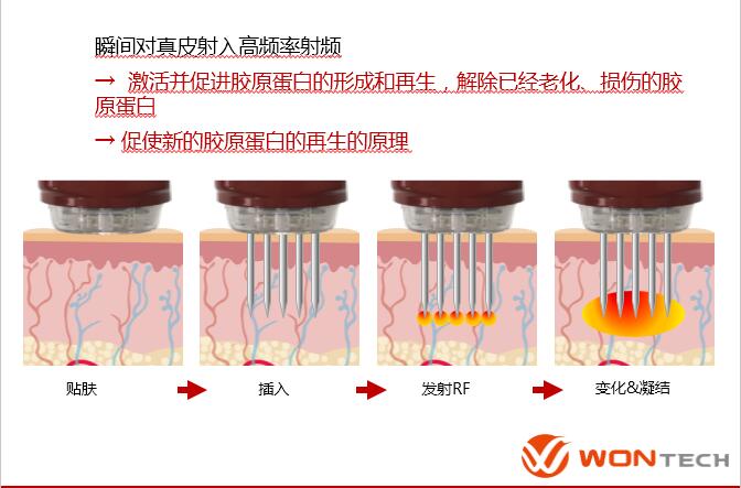 FEI(妃)黄金射频微针高频率射频,热门黄金微针盘点