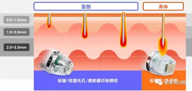 secert射频微针优势,黄金微针,热门黄金微针盘点