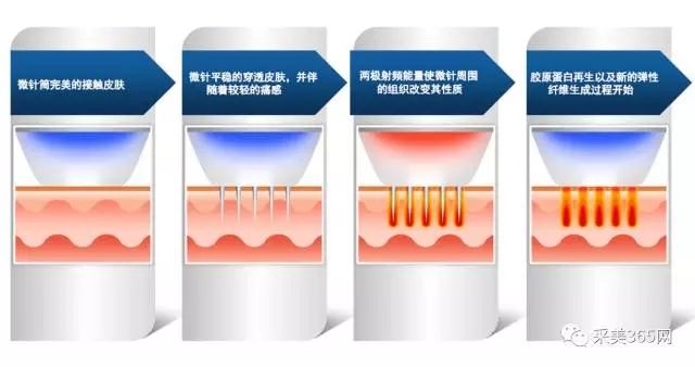 易路达,SECRET射频微针工作原理 ,黄金微针,盘点热门黄金微针