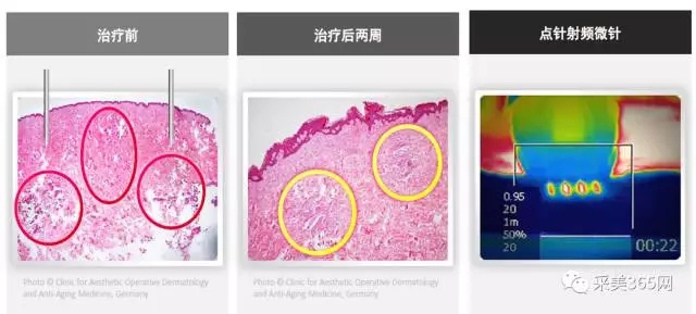 secert射频微针治疗后组织学分析,黄金微针