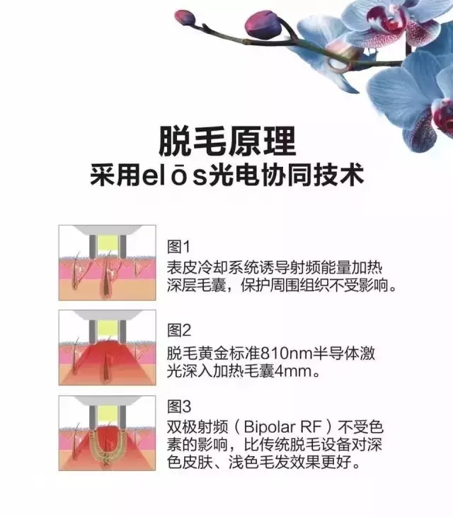 elase闪频无痛脱毛 原理