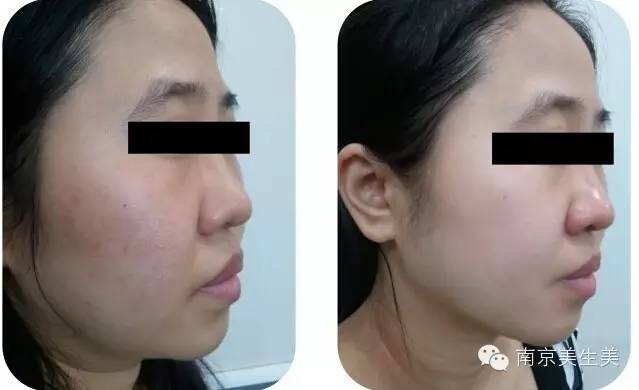 博瑞莱Brera临床案例:面部紧致