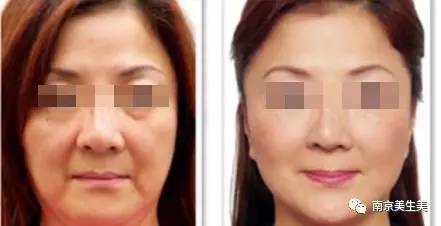 博瑞莱Brera临床案例:法令纹淡化