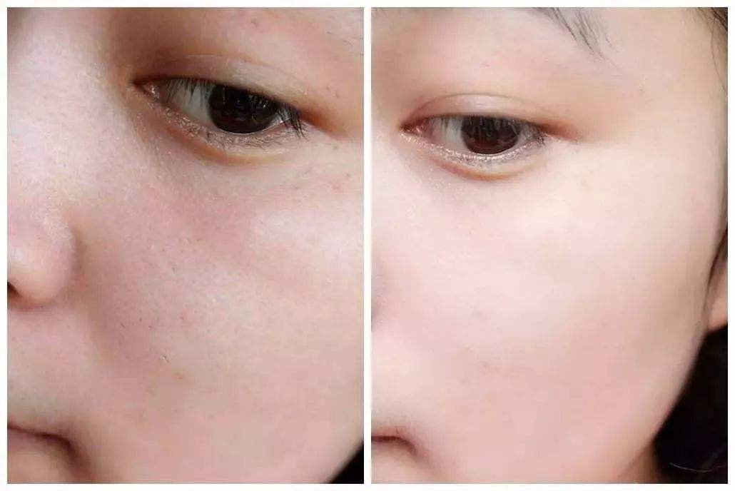 童颜针 热玛吉和水光针的区别 采美365网