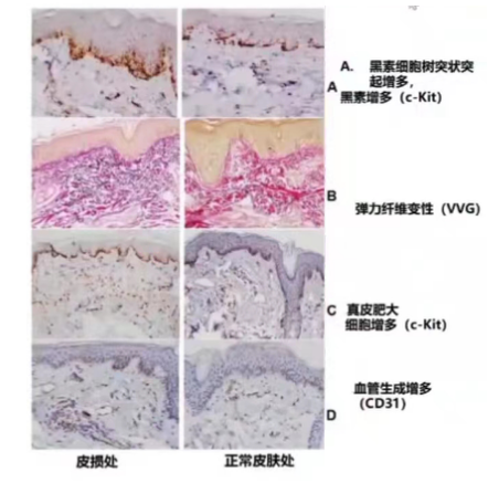 褐青色斑图片病理图片